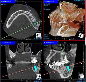 シミュレーション