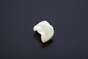 ジルコニアインレー