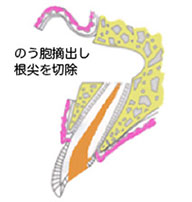 のう胞摘出し根尖を切除